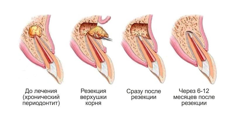 Резекция верхушки корня зуба