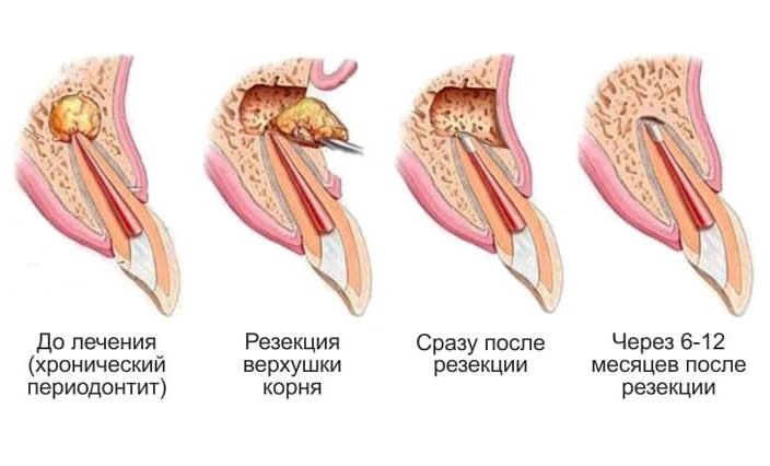 Резекция верхушки корня зуба