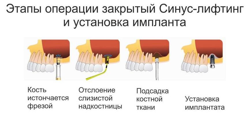 этапы закрытого синус-лифтинга