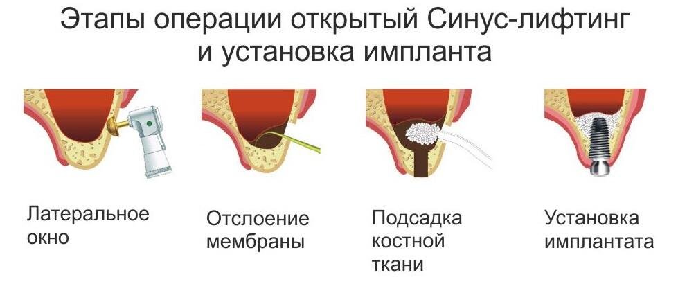 этапы открытого синус-лифтинга