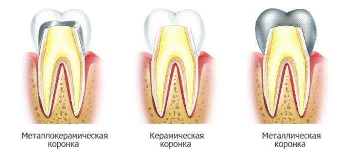 виды коронок
