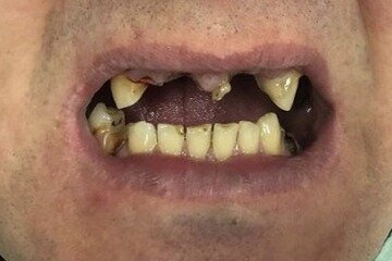 Имплантация с немедленной нагрузкой