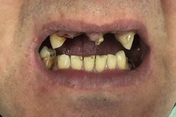 Имплантация с немедленной нагрузкой