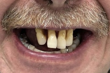 Имплантация по методу All-on-4.