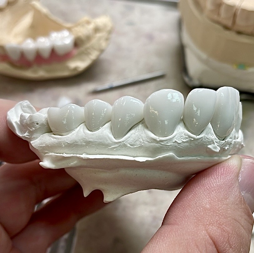 керамические виниры 