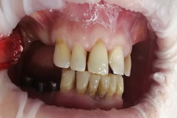 На нижней челюсти проведена имплантация в области жевательных зубов