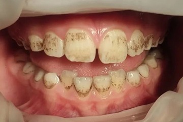 Профессиональная гигиена полости рта.