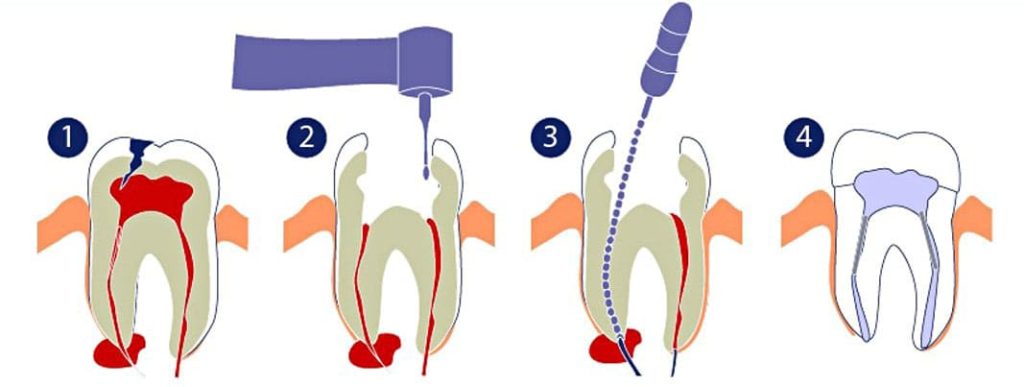 этапы лечения кисты зуба