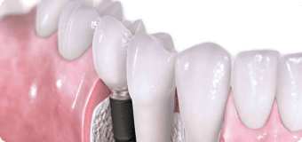 Имплантация зубов Straumann