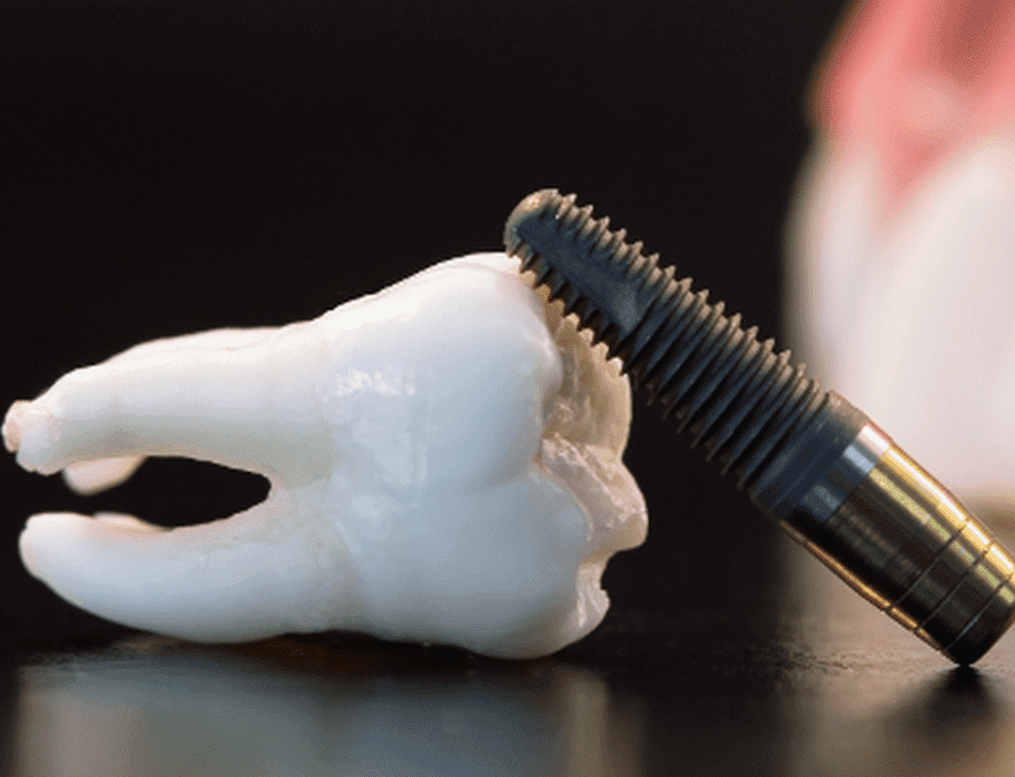 одномоментная имплантация зубов 
