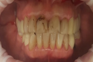Керамические виниры из пресс-керамики E-max на фронтальные зубы