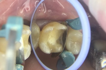 Восстановление 16 зуба после повторного эндодонтического лечения