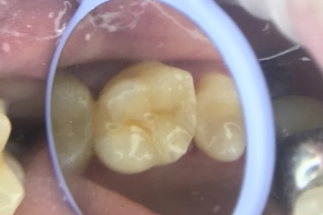 Восстановление 16 зуба после повторного эндодонтического лечения