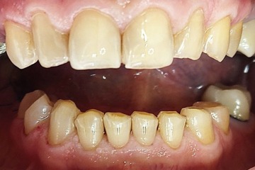 Композитные виниры. Выполнены на фронтальной группе зубов нижней челюсти.