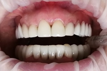 На нижней челюсти проведена имплантация в области жевательных зубов
