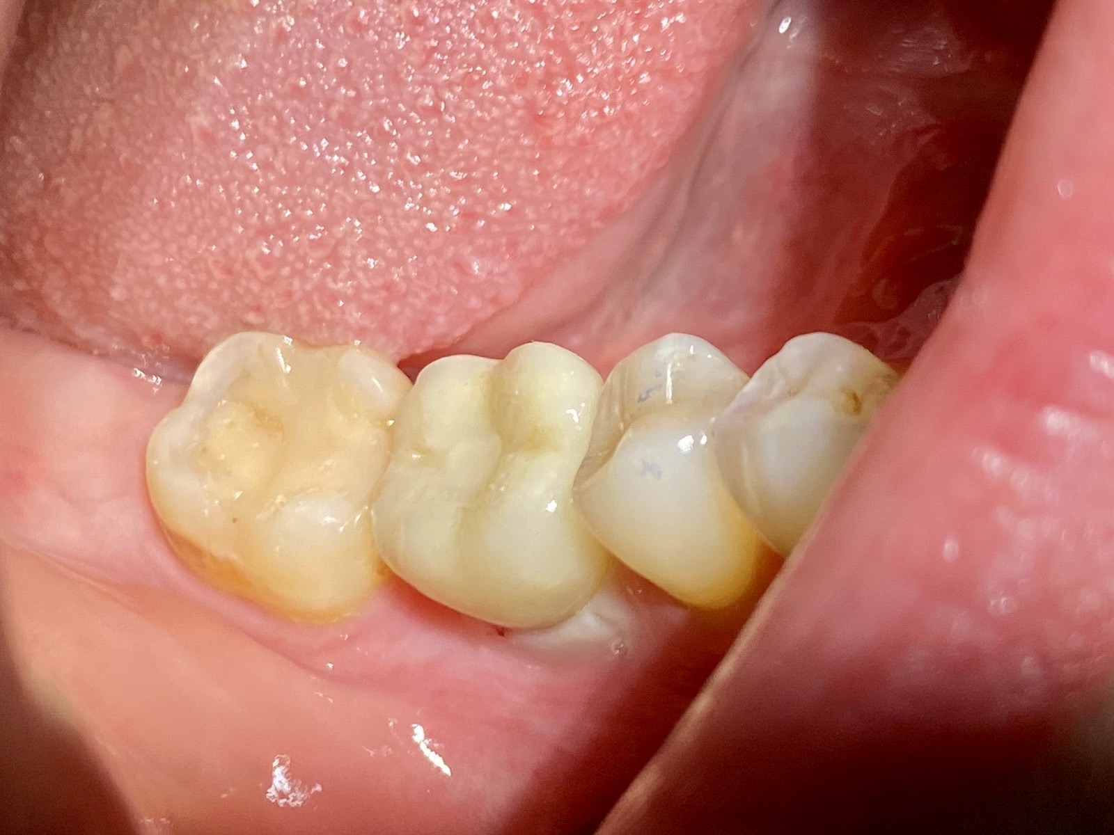 одномоментная имплантация 