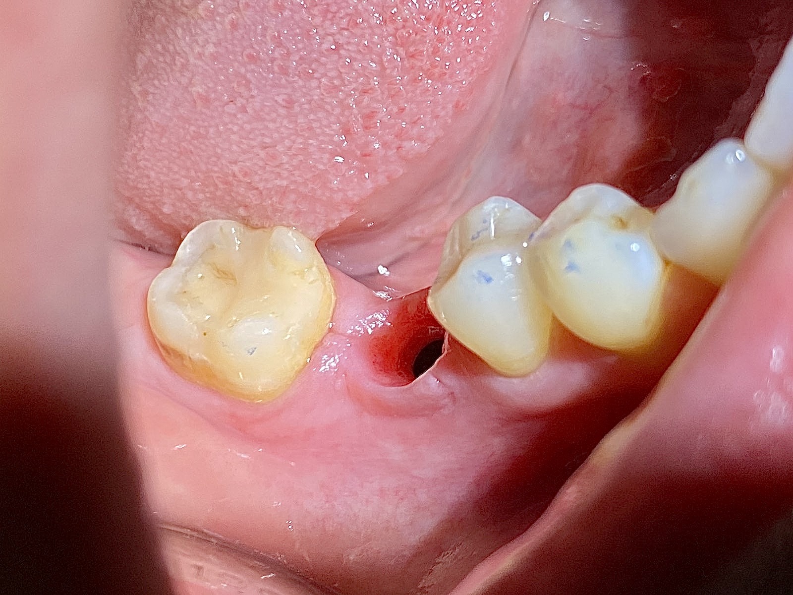 зуб после удаления