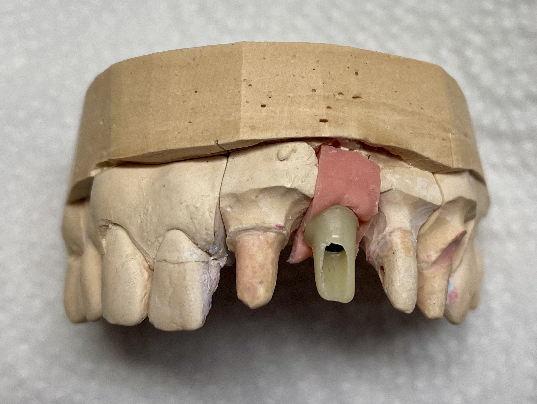 протезирование на имплатнте