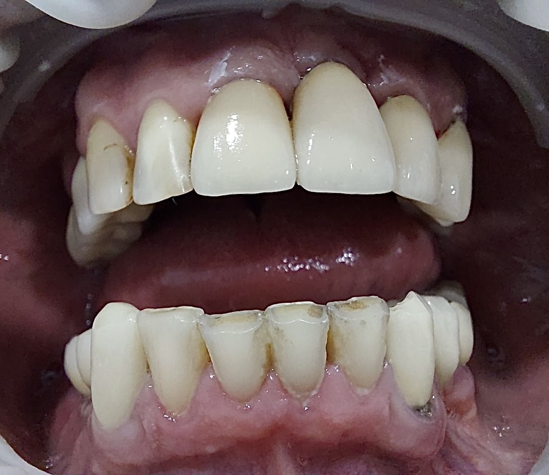 результат протезирования