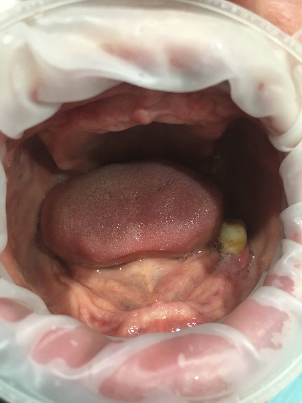 пациент до установки протезов