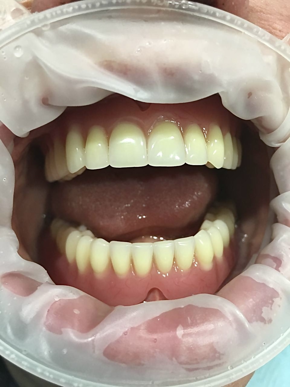 установка съемных протезов