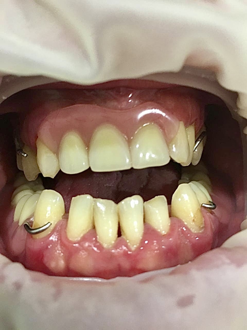 съемный протез