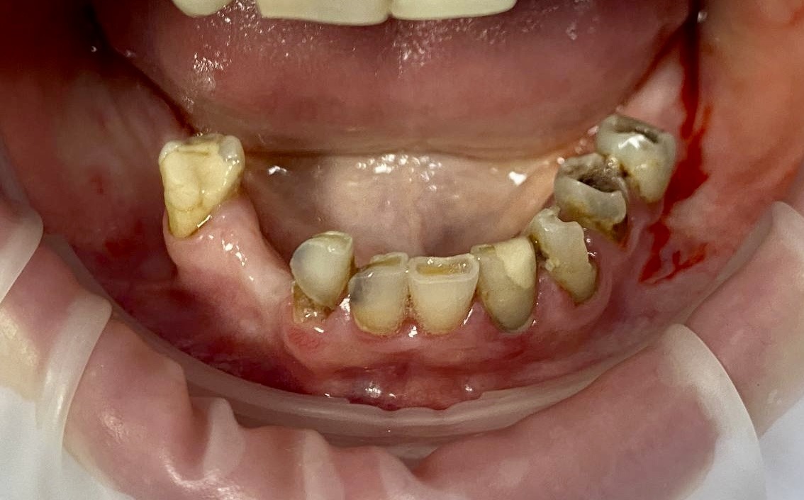 пациент до имплантации