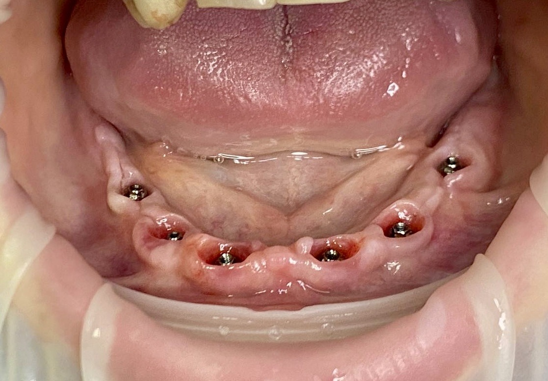 установка имплантов