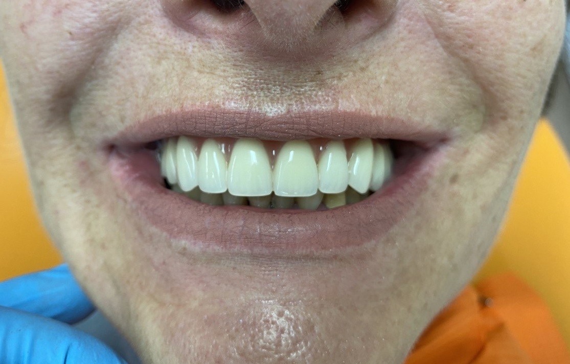 восстановление по методике все-на-4 