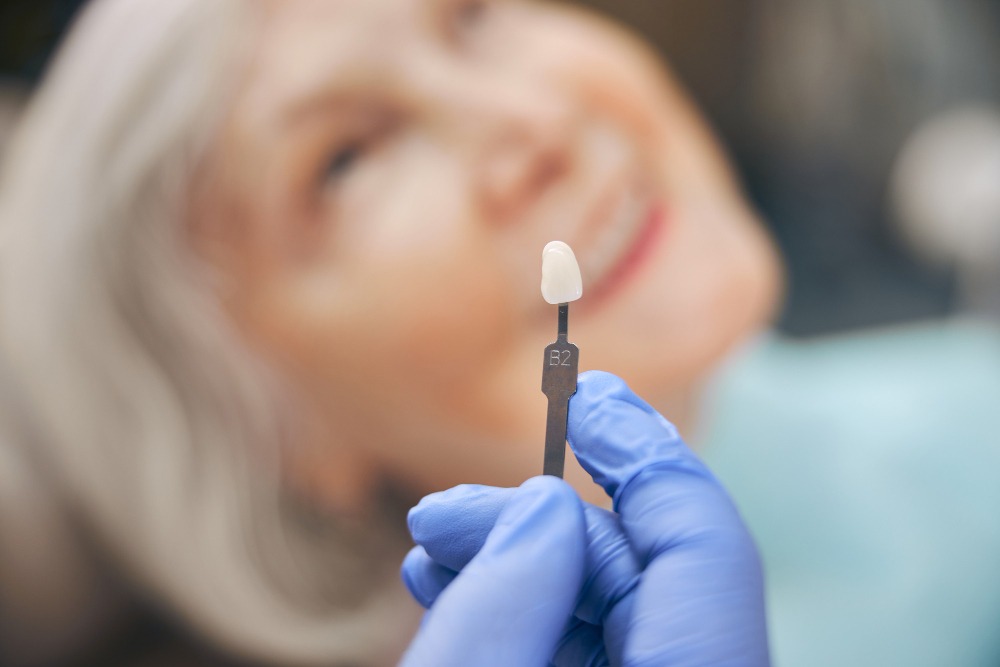 Керамические виниры