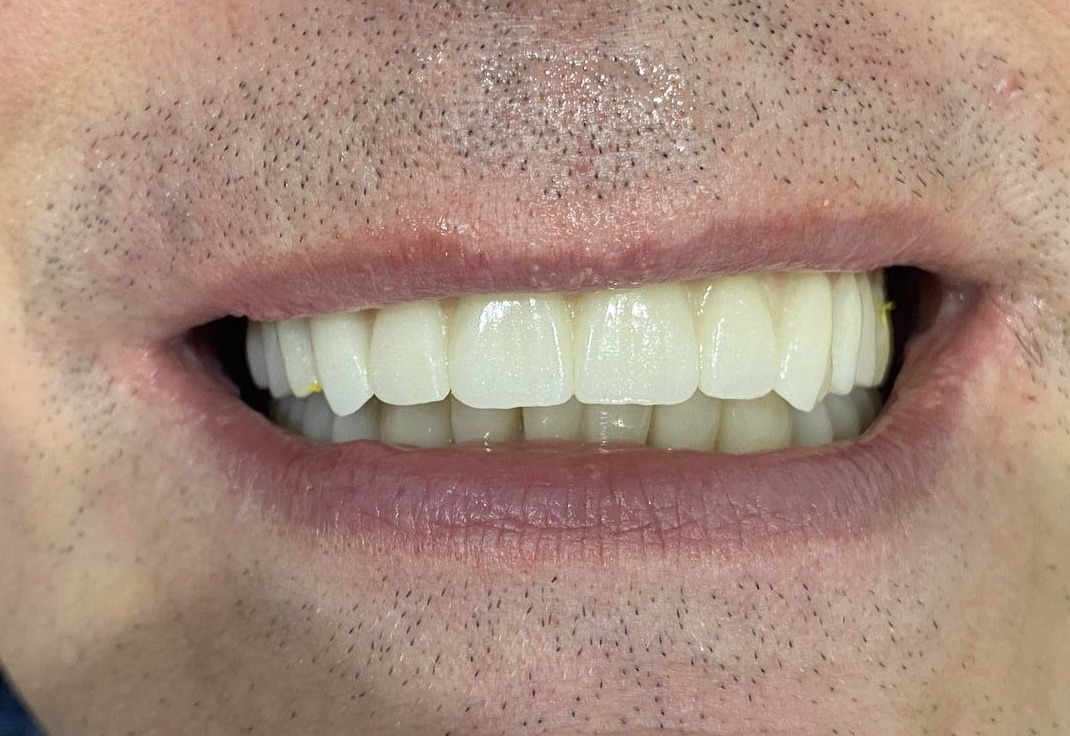 результат имплантации