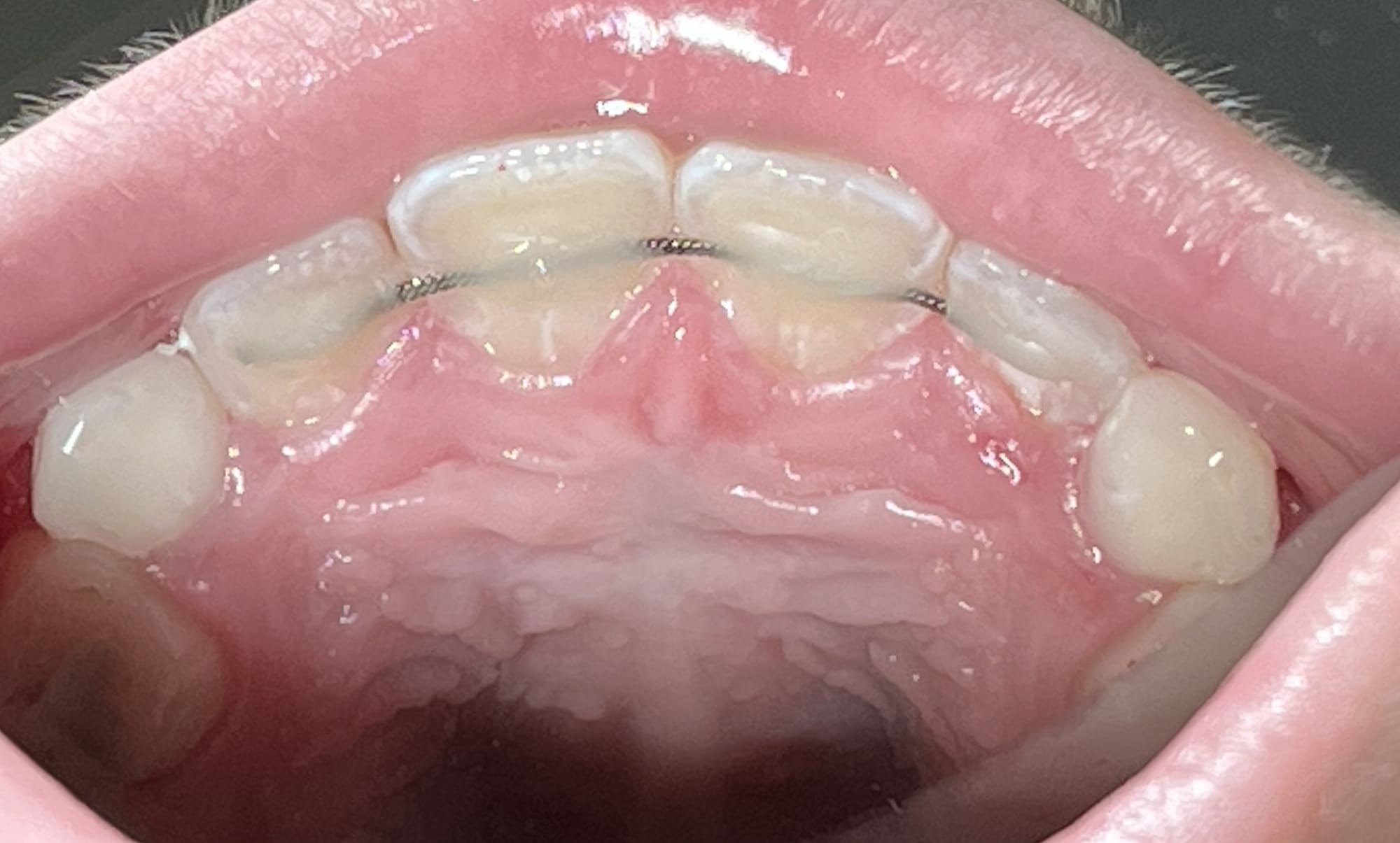 во время лечения