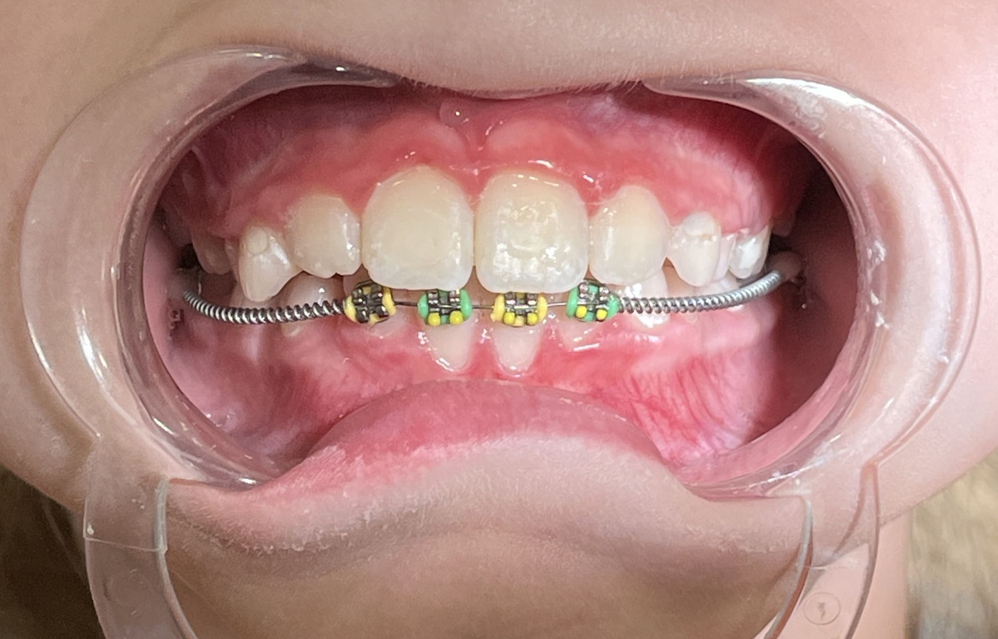 во время лечения