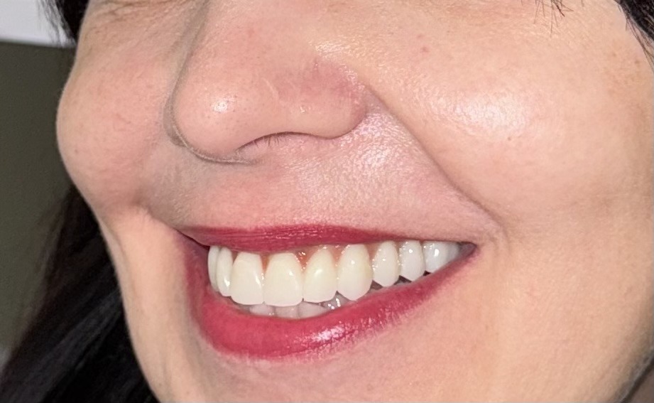 результат протезирования