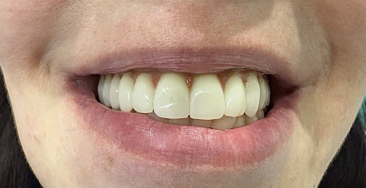 протезирование