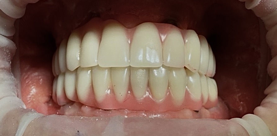 имплантация