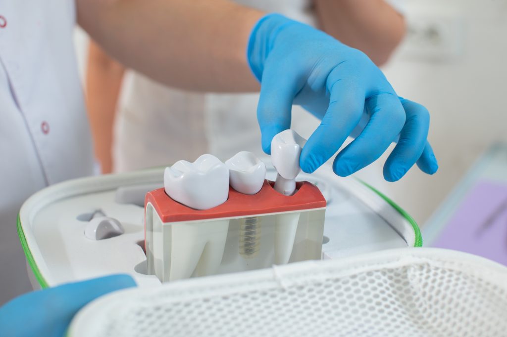 протезирование зубов