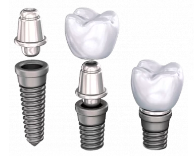 имплант зуба