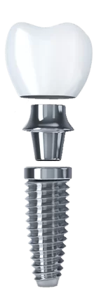 имплантация зубов