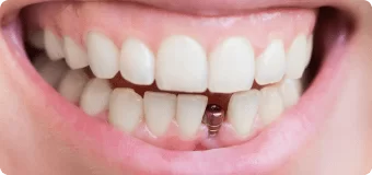 Одноэтапная имплантация