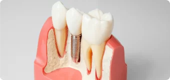 Двухэтапная имплантация