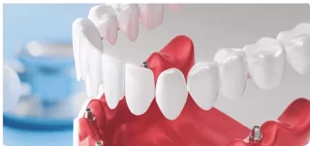 Одномоментная имплантация