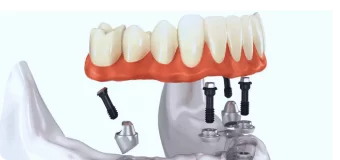 Имплантация зубов All-on-4/6