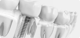 Имплантация зубов Osstem