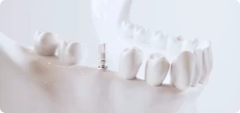 Имплантация зубов MegaGen