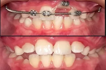 С помощью частичной брекет-системы зуб вернули в зубной ряд