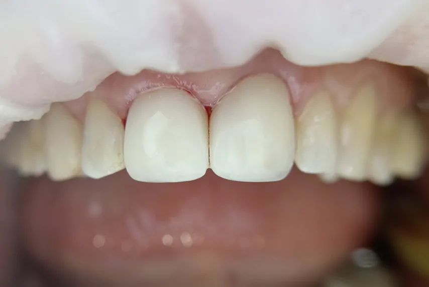 композитные виниры