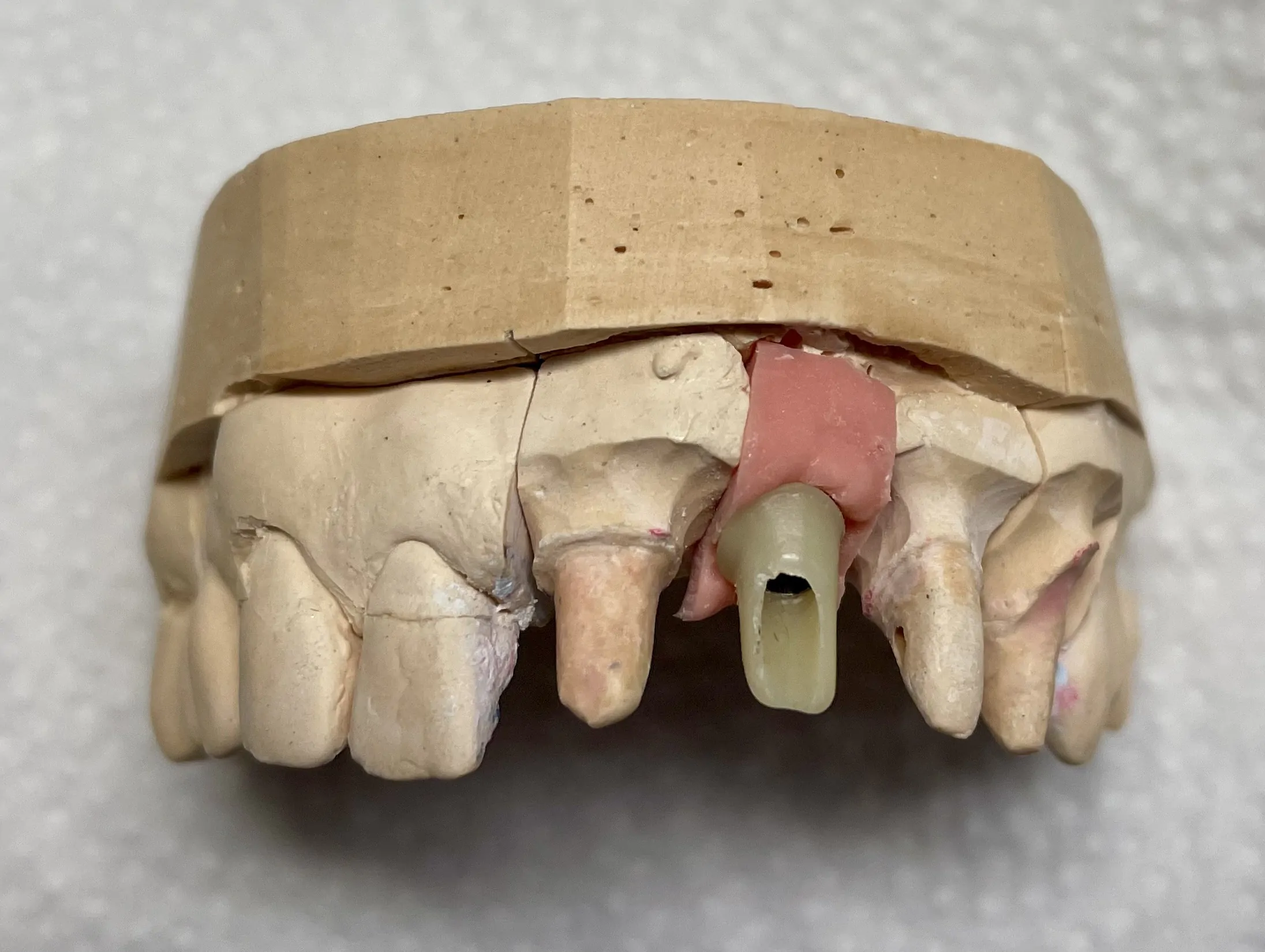 протезирование на имплатнте