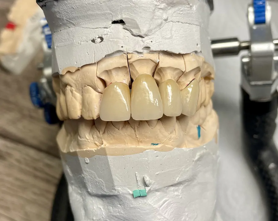 коронки для протезирования