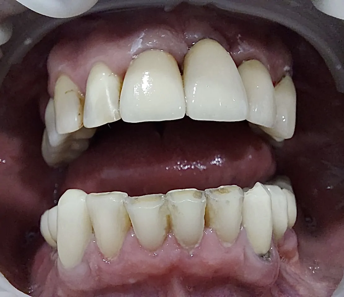 результат протезирования